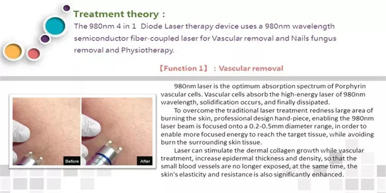 5 in 1 980nm Diode Laser Vascular Removal Machine for Spider Veins & Nail Fungus Treatment Home Beauty Care Equipment 2026