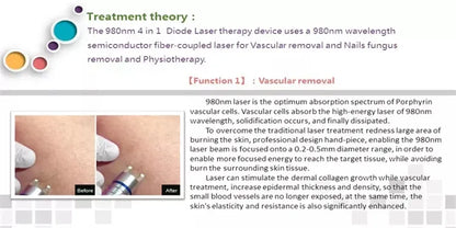 5 in 1 980nm Diode Laser Vascular Removal Machine for Spider Veins & Nail Fungus Treatment Home Beauty Care Equipment 2026