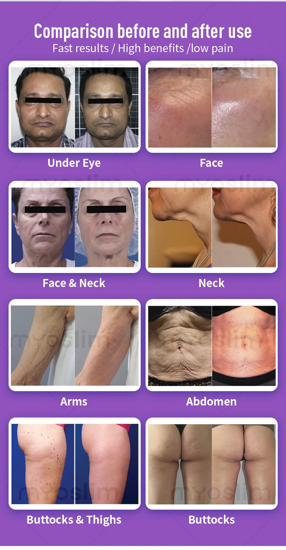 4D Cavitation Beauty Machine for Body Sculpting, Wrinkle Reduction, Contour Refining, Stretch Mark Fading and Cellulite Removal