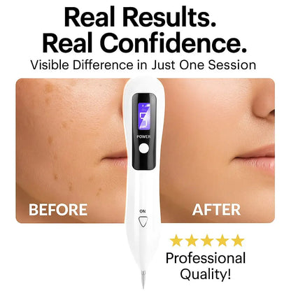 Portable LCD mole and freckle removal pen | Picosecond laser tattoo removal device | Home painless beauty device | Mole, freckle and tattoo three-in-one