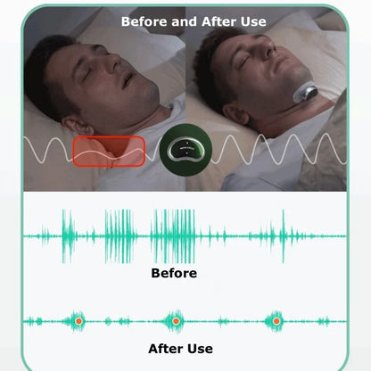 Anti Snoring Smart Device for Adult Sleep Aid to Stop Snoring Analyze Sleep and Snoring Data Wirelessly