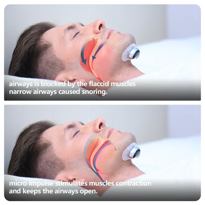 Anti Snoring Smart Device for Adult Sleep Aid to Stop Snoring Analyze Sleep and Snoring Data Wirelessly