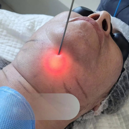 980nm 1470nm Laser Facial Tightening Device Fiber Optic Lifting Neck Sculpting Skin Firming Beauty Equipment