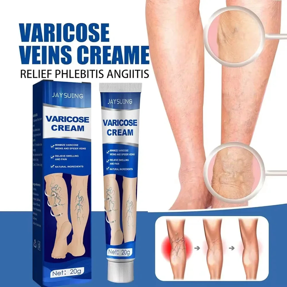 Ointment for Varicose Veins Eliminate Vasculitis Phlebitis to Relieve Spider Leg Pain Treatment Herbal cream