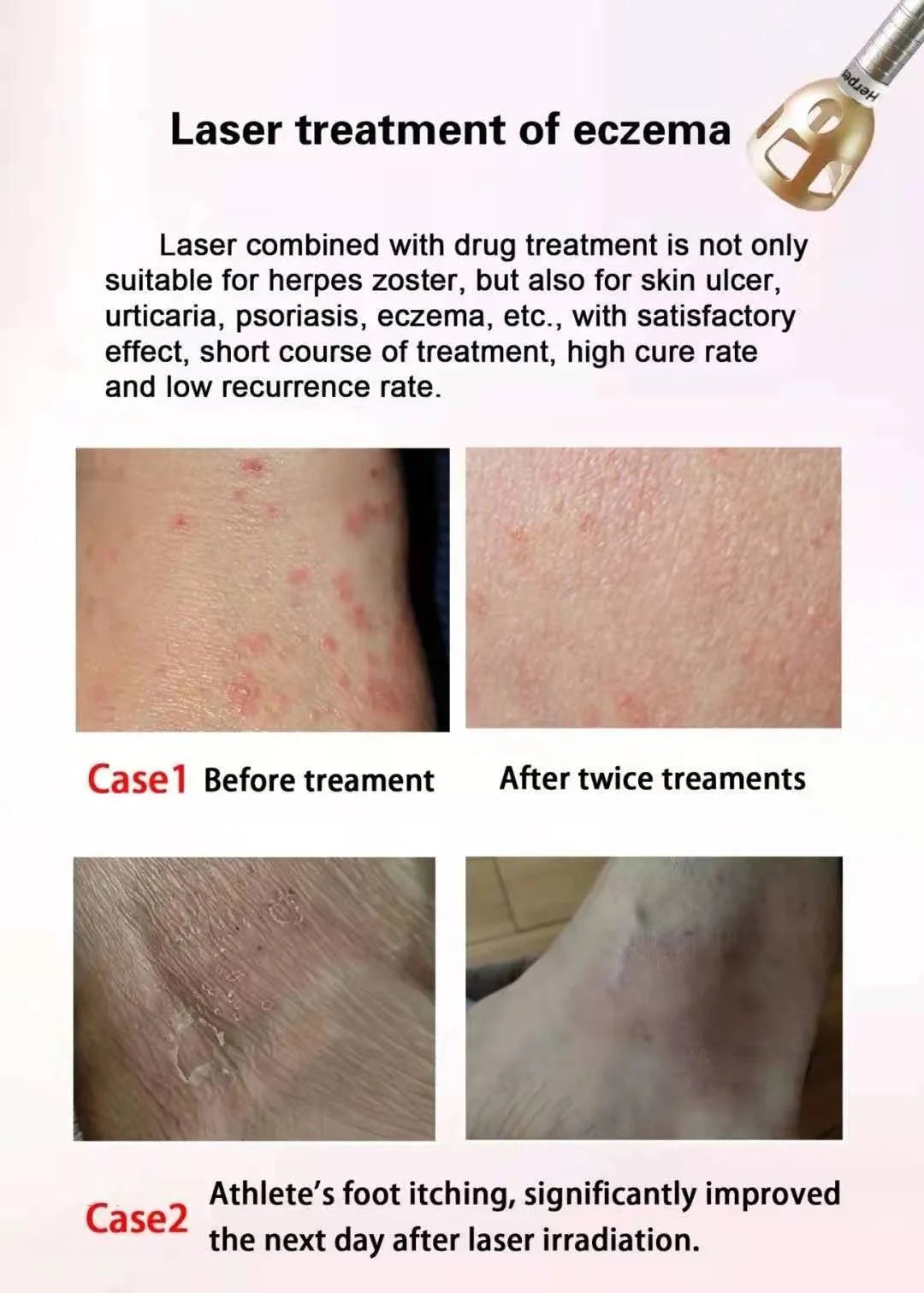 5 in 1 980nm Diode Laser Vascular Removal Machine for Spider Veins & Nail Fungus Treatment Home Beauty Care Equipment 2026