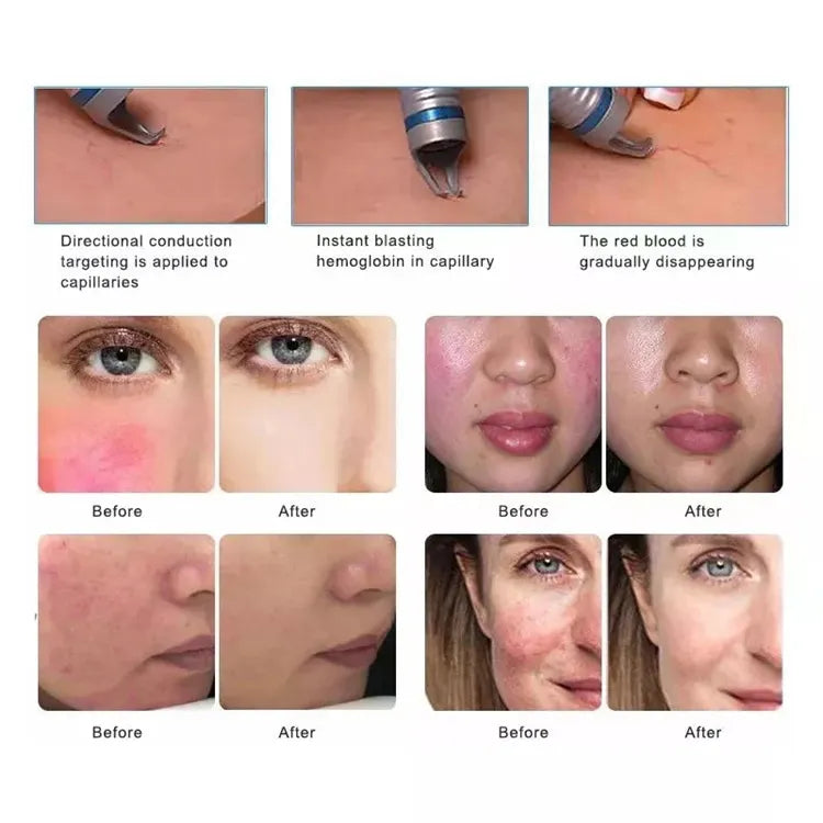 5 in 1 980nm Diode Laser Vascular Removal Machine for Spider Veins & Nail Fungus Treatment Home Beauty Care Equipment 2026