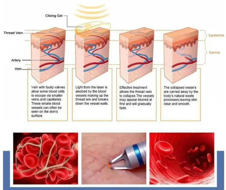 5 in 1 980nm Diode Laser Vascular Removal Machine for Spider Veins & Nail Fungus Treatment Home Beauty Care Equipment 2026