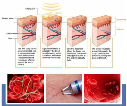 5 in 1 980nm Diode Laser Vascular Removal Machine for Spider Veins & Nail Fungus Treatment Home Beauty Care Equipment 2026